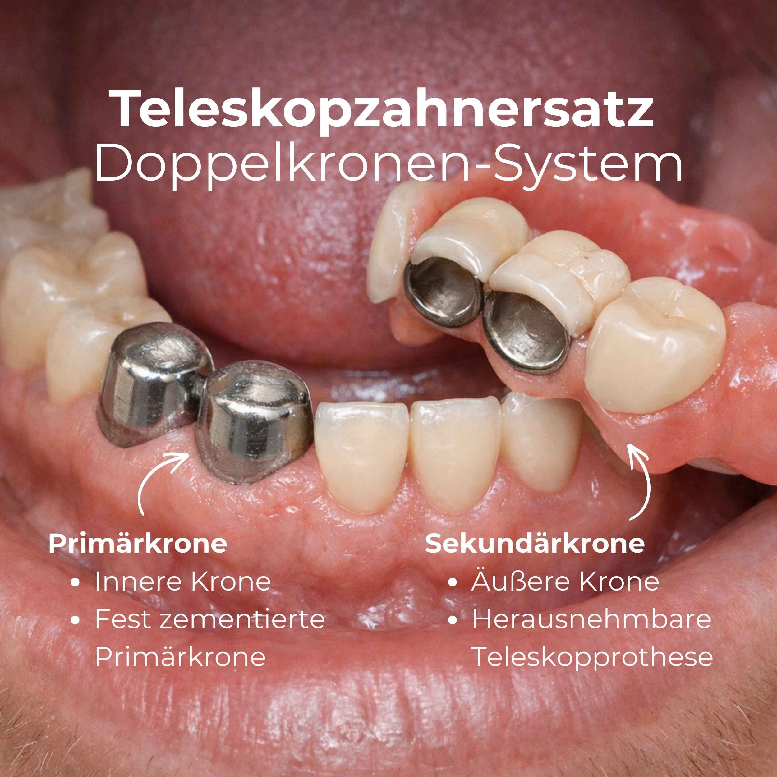 Teleskopzahnersatz Doppelkronen-System – Zahnersatz in Mönchengladbach